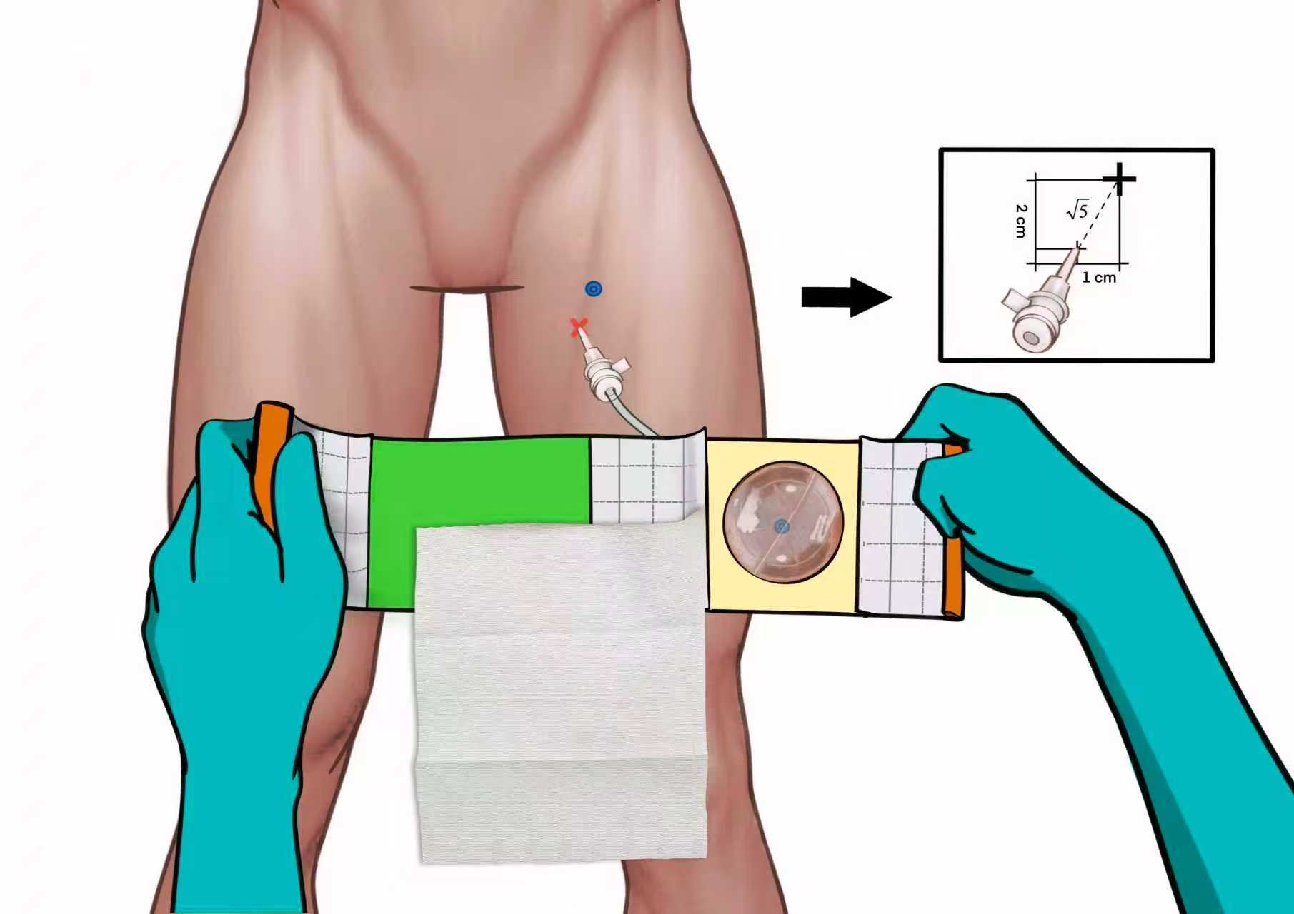 Femoral Hemostasis Compressor